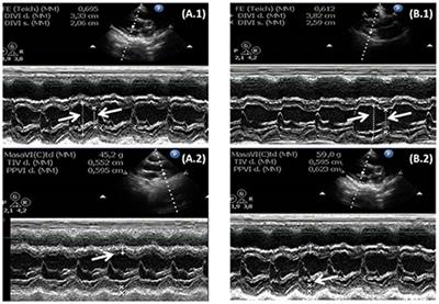 Short-Term Evaluation of Left Ventricular Mass and Function in Children With Growth Hormone Deficiency After Replacement Treatment